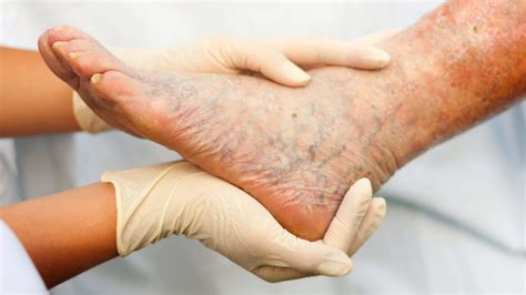 Эффективное лечение варикоза на ногах в Крыму